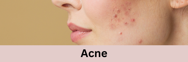 Collection Of Skin Care Products For Acne Concern 