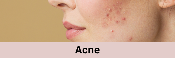 Collection Of Skin Care Products For Acne Concern
